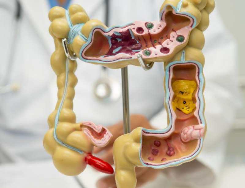 Ministério da Saúde inclui novo teste no SUS para rastrear câncer de intestino