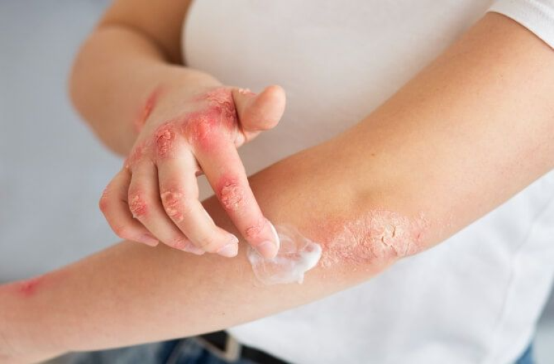 Santo Ângelo registra 67 casos positivos de sífilis em 2026