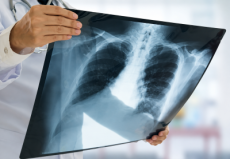 Fiocruz aponta RS entre Estados com aumento das internações por infecções respiratórias