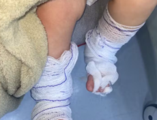 Bebê de 11 meses tem queimaduras de 2º grau após banho em escola no RS, diz mãe
